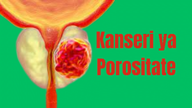 Ibimenyetso bya kanseri ya prostate n'uko wayirinda